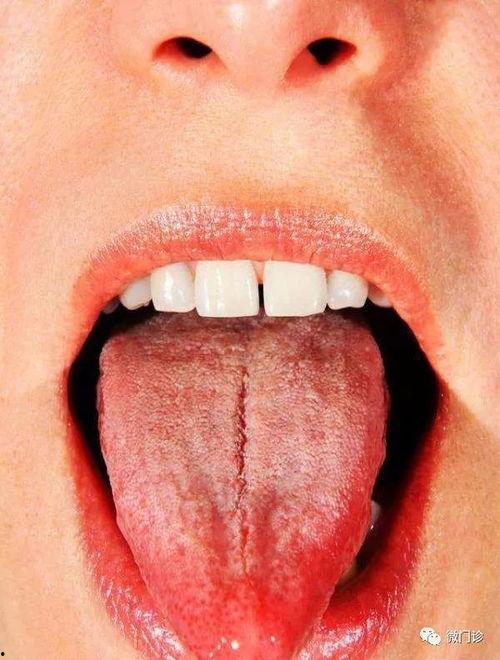吃小瓜舌头裂纹  第1张