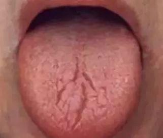 吃小瓜舌头裂纹  第2张